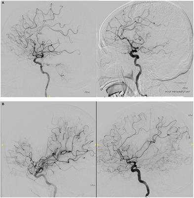 Evidence-Based Updates to Thrombectomy: Targets, New Techniques, and Devices